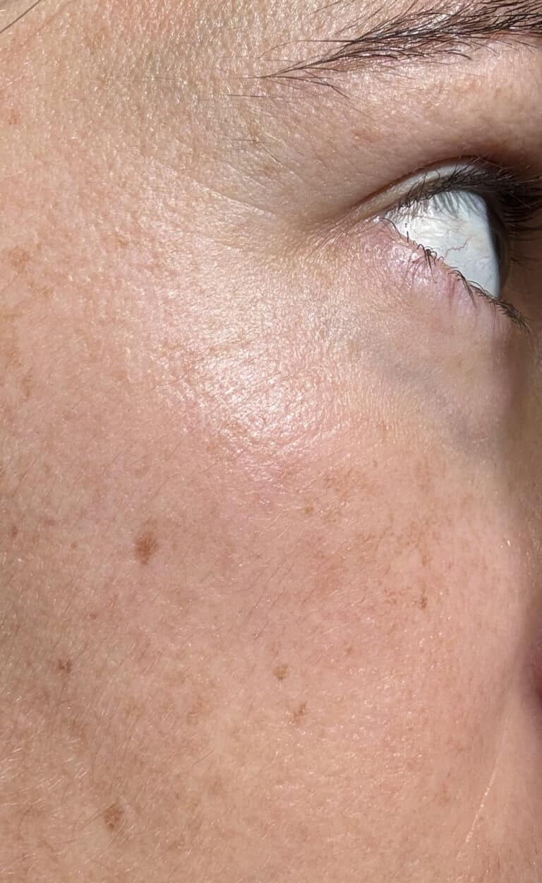 After Image: Hyperpigmentation Treatment with Cryotherapy - right-front-oblique