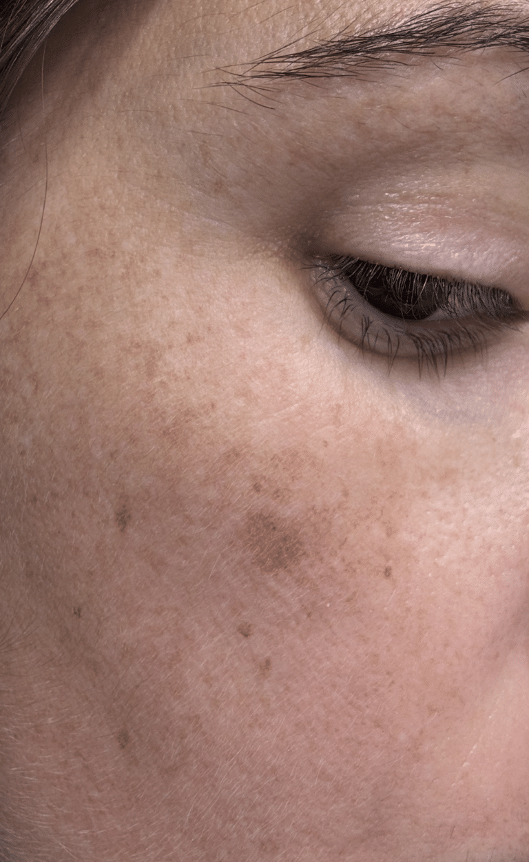 Before Image: Hyperpigmentation Treatment with Cryotherapy - right-front-oblique