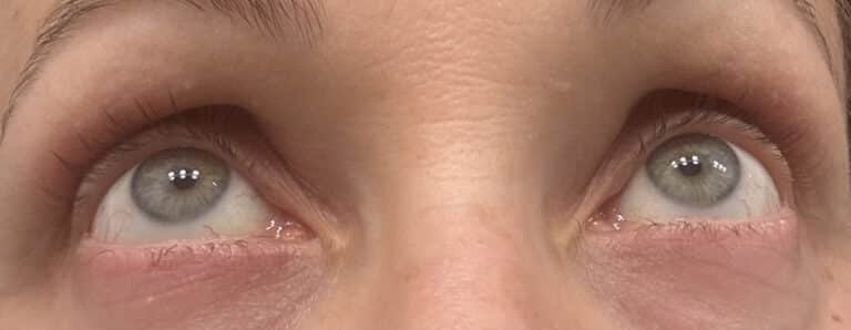 Before Image: Latisse - front