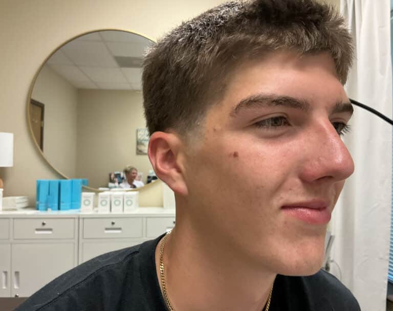 After Image: Acne Treatment - right-front-oblique