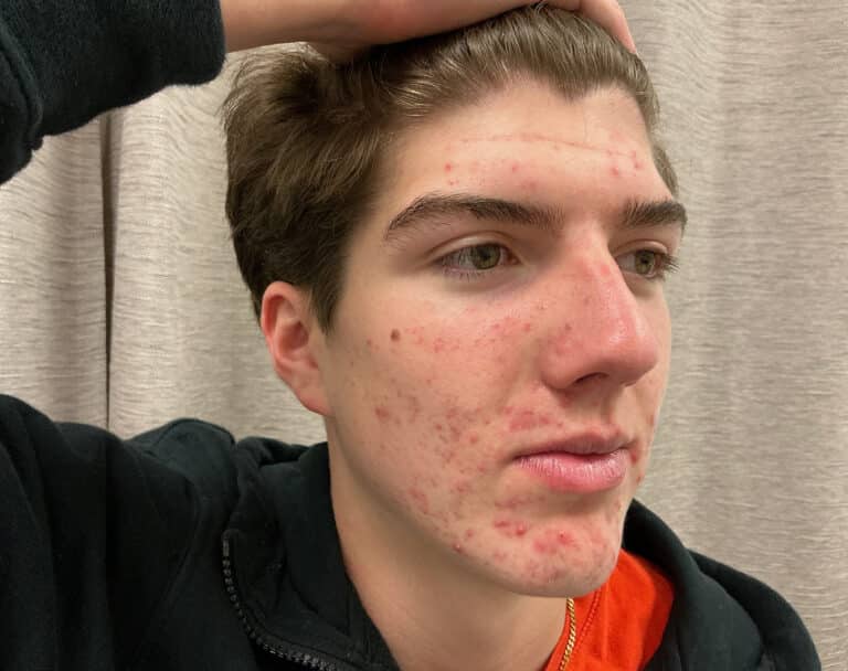 Before Image: Acne Treatment - right-front-oblique