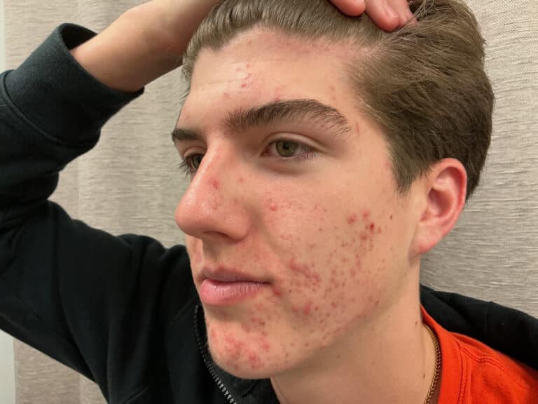 Before Image: Acne Treatment - left-front-oblique