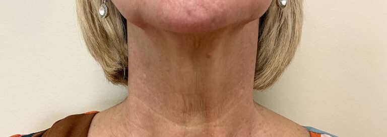 After Image: Ultra Clear Laser - front