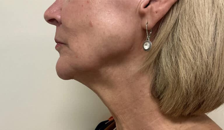 After Image: Ultra Clear Laser - left-side