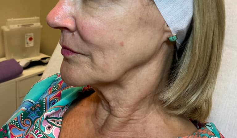 Before Image: Ultra Clear Laser - left-side
