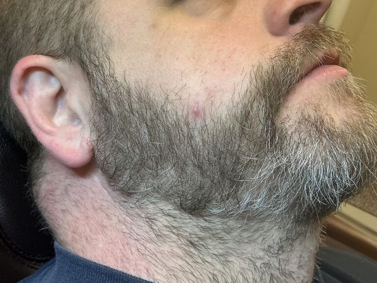 After Image: Alopecia Areata - right-front-oblique