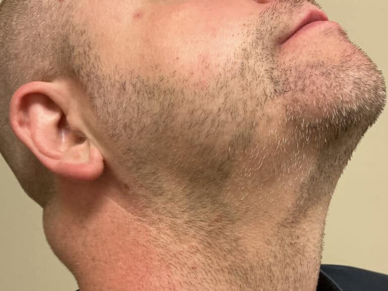 Before Image: Alopecia Areata - right-front-oblique