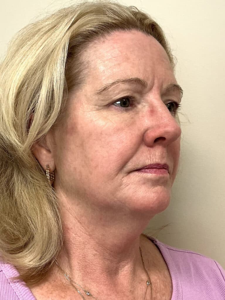 After Image: UltraClear - right-front-oblique