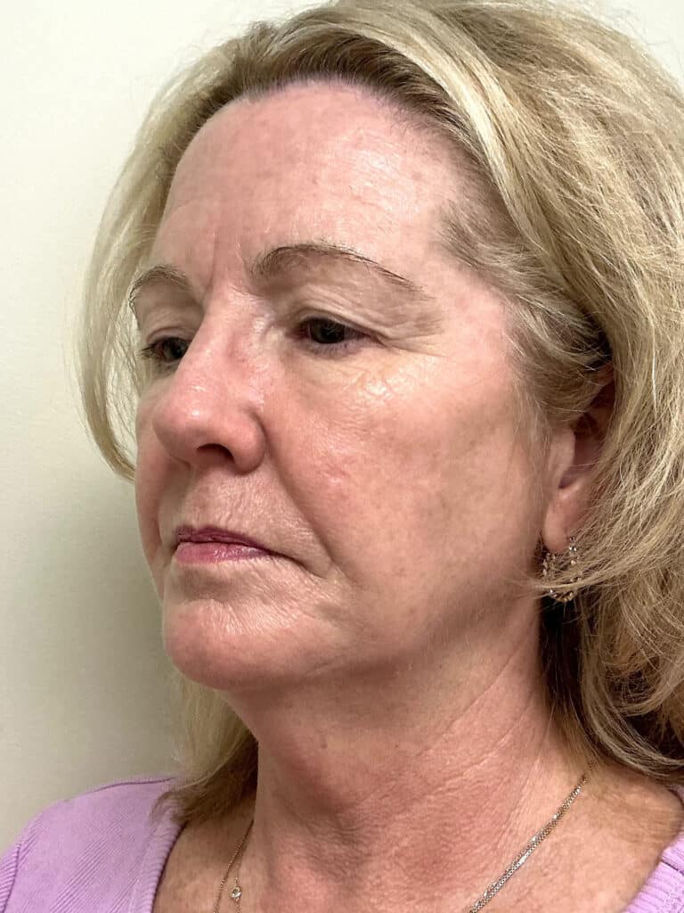 After Image: UltraClear - 