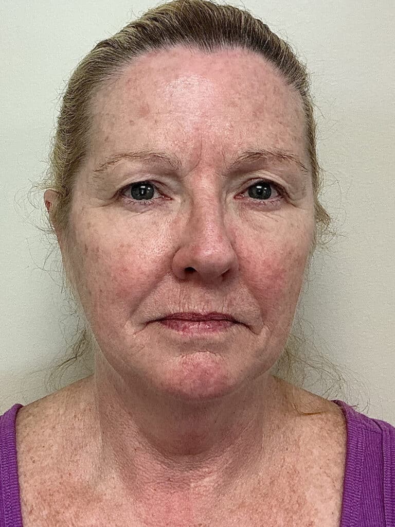 Before Image: UltraClear - front