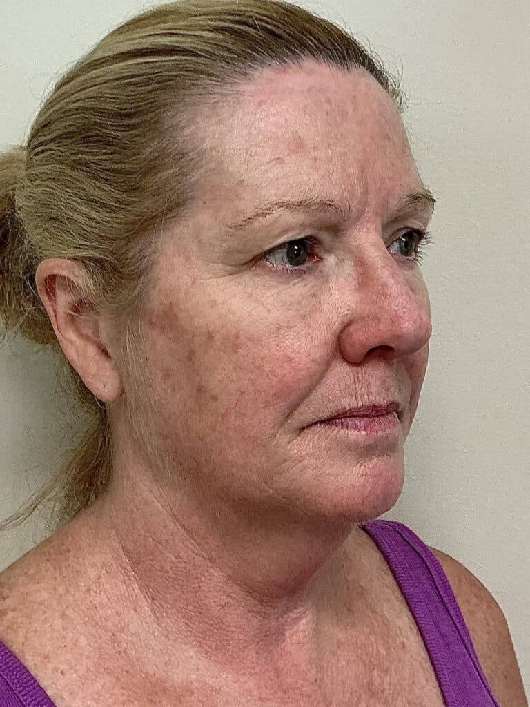 Before Image: UltraClear - right-front-oblique