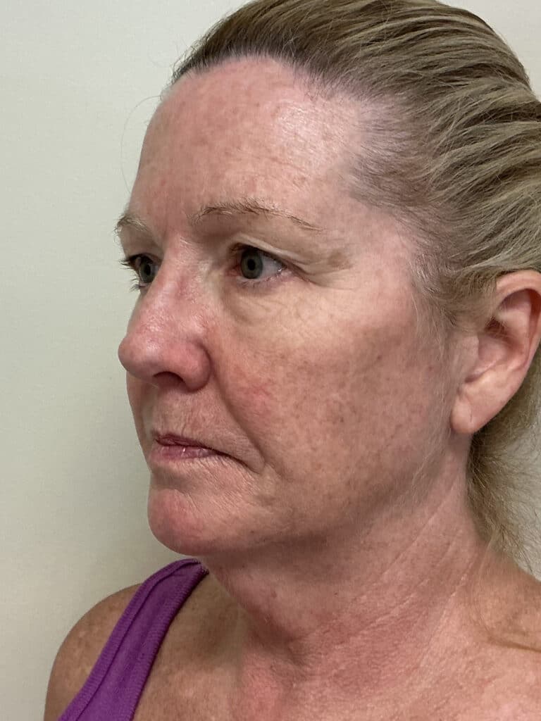 Before Image: UltraClear - 