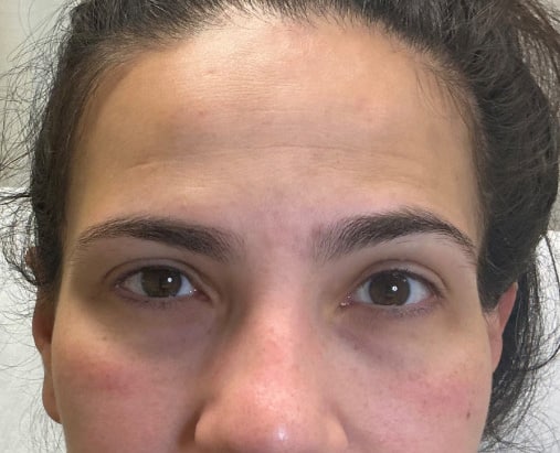 Before Image: Ariessance Pure PDGF Under Eye Treatment - front