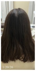After Image: Alopecia
