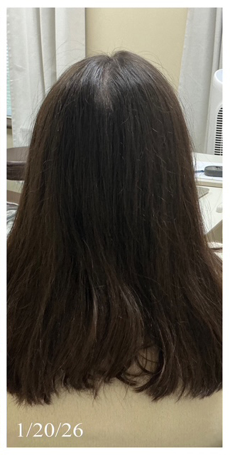 After Image: Alopecia - back