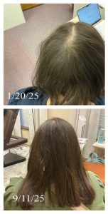 Before Image: Alopecia