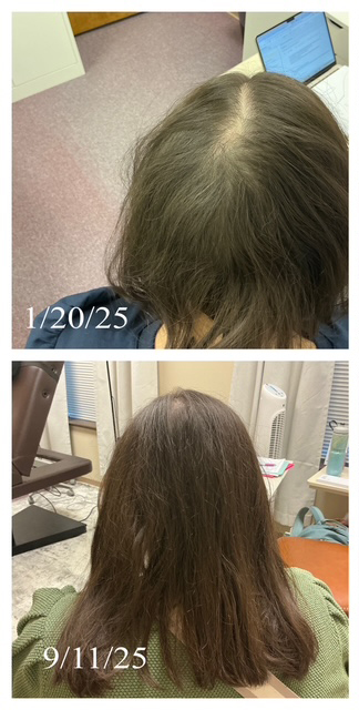 Before Image: Alopecia - back