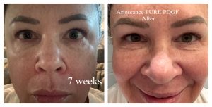 After Image: Ariessance Pure PDGF Under Eye