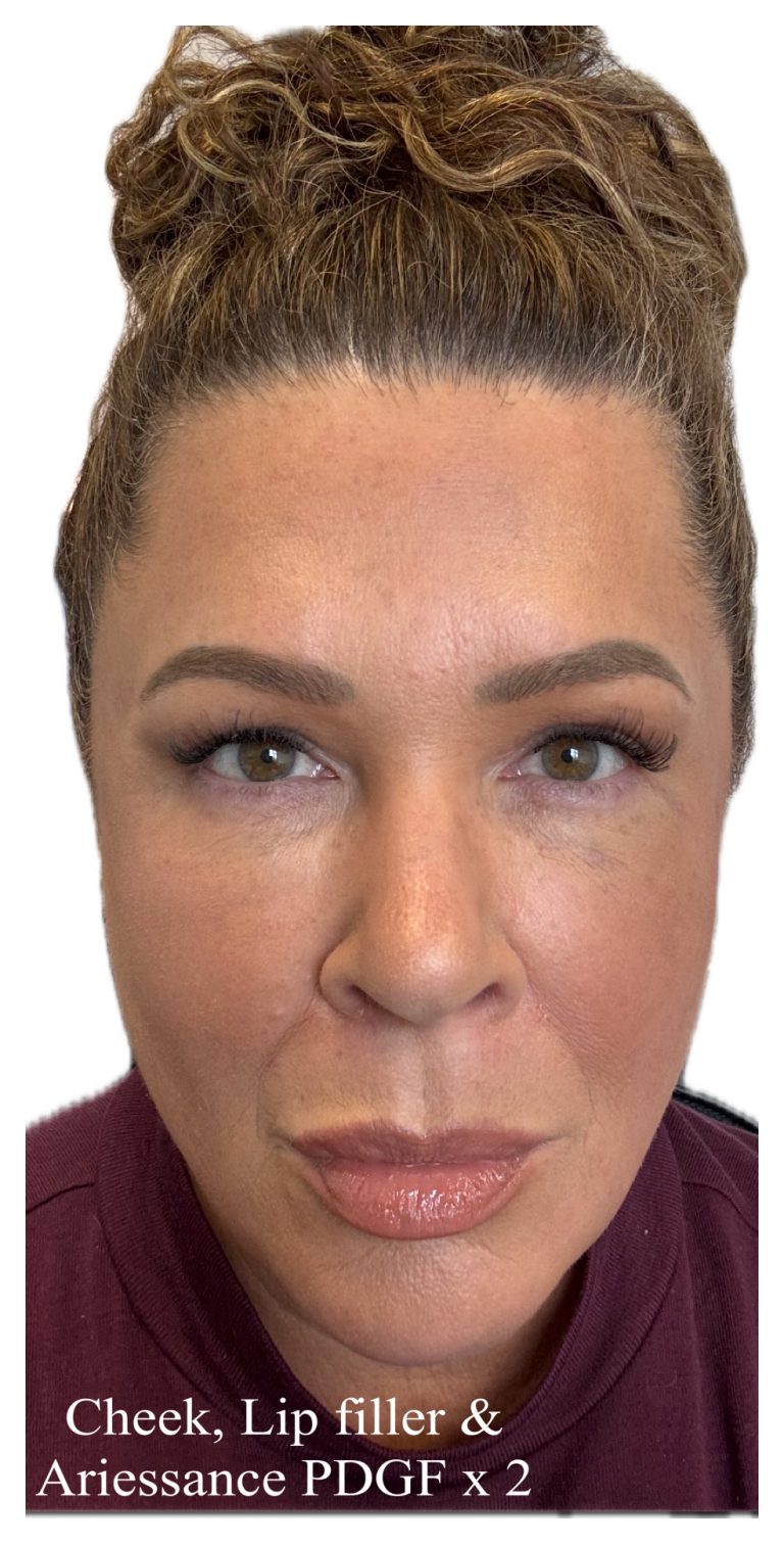 After Image: Ariessance Pure PDGF Under Eye - 