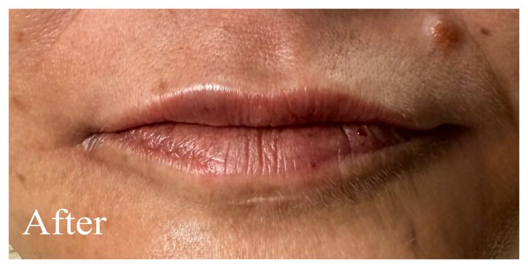 After Image: Lip & Peri-oral filler - front