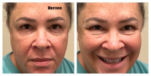 Before Image: Ariessance Pure PDGF Under Eye