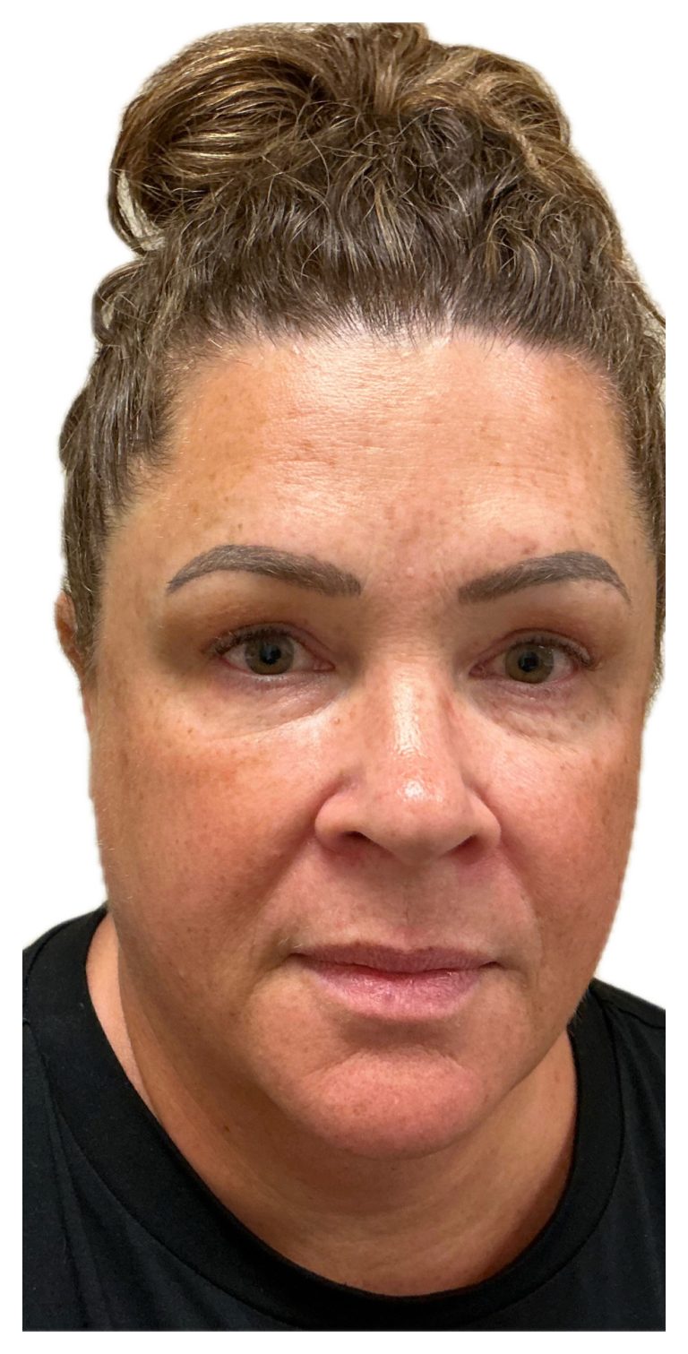 Before Image: Ariessance Pure PDGF Under Eye - 