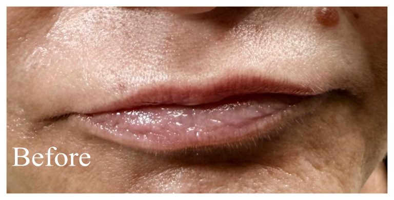 Before Image: Lip & Peri-oral filler - front